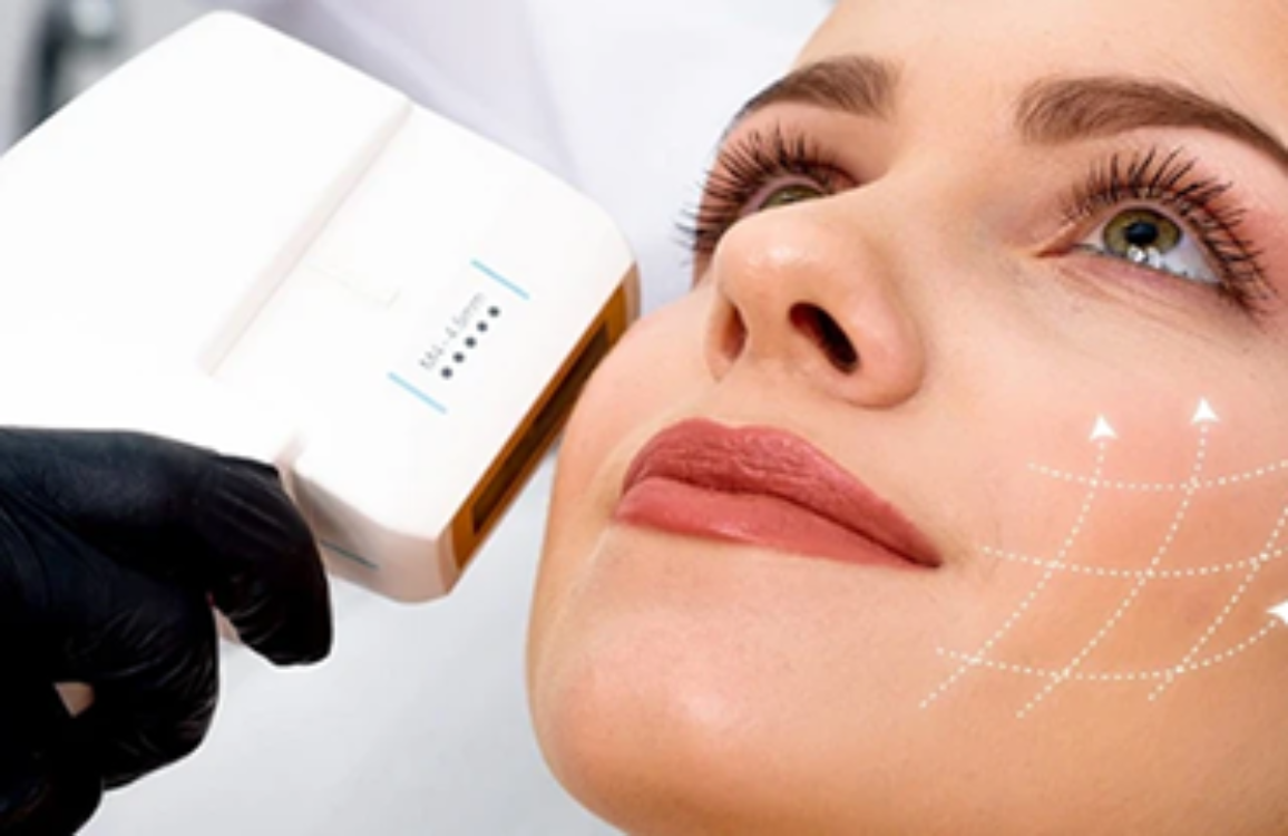 HIFU - Ultrasom Micro Focado